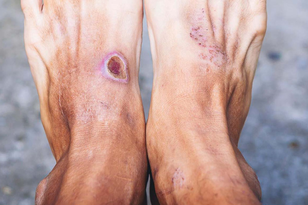 diabetic foot ulcer