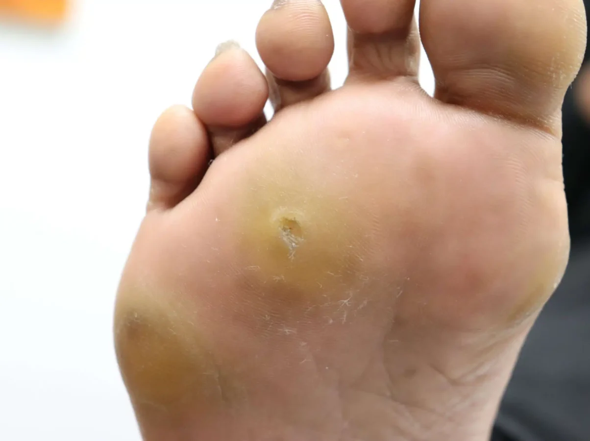 foot-corn-3