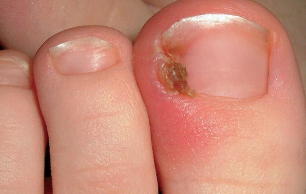 ingrown-nail-