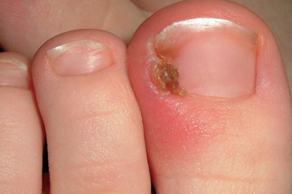 ingrown-nail-